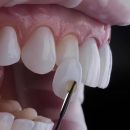 Виниры: Искусство преображения улыбки в Ташкенте